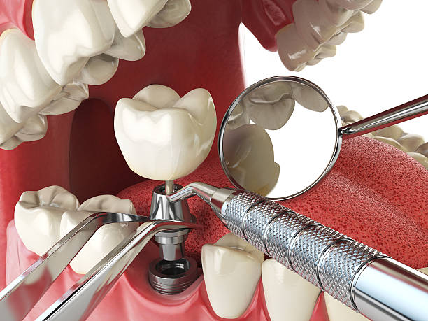 Best Emergency Broken Tooth Repair in St Maries, ID